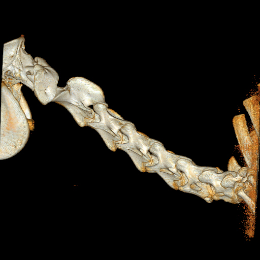 3D Rekonstruktion der Halswirbelsäule
