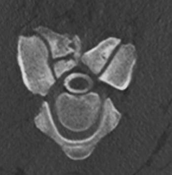 Transversales CT Bild der Halswirbelsäule mit Kontrastmittel (Myelographie)