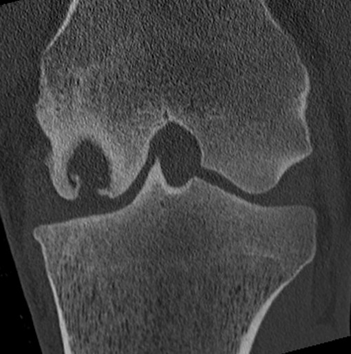 CT Bild Kniegelenk mit Zyste