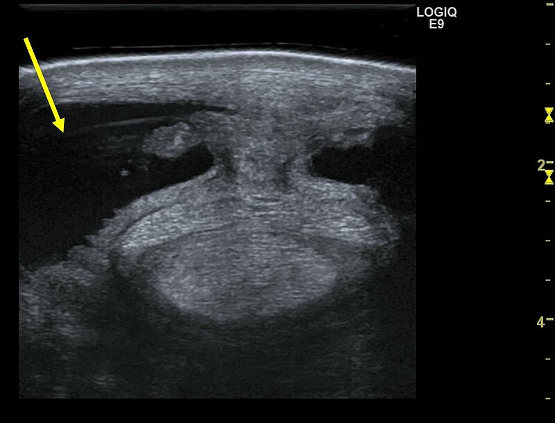 Ultraschalluntersuchung einer Sehne - der Pfeil zeigt eine deutlich vermehrt gefüllte Fesselbeugesehnenscheide