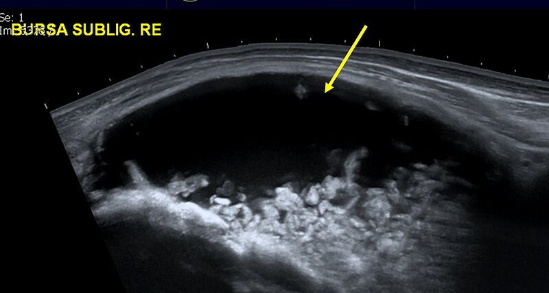 Ultraschalluntersuchung des Nackens - der Pfeil zeit eine hochgradige Füllung des Schleimbeutels unter dem Nackenband