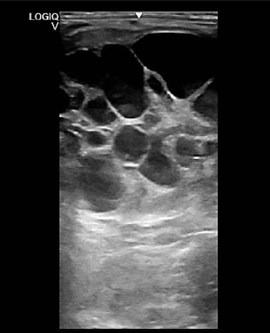 Ultraschallbild eines tumorös veränderten Eierstockes