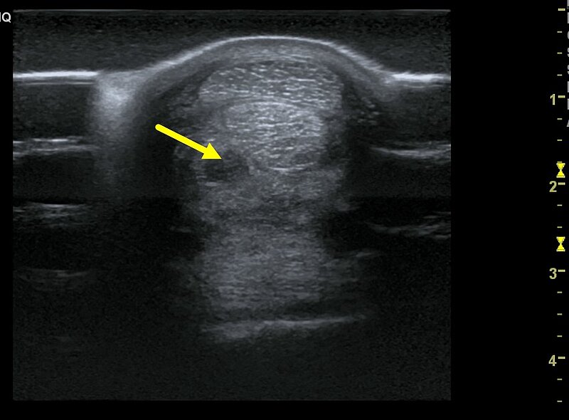 Ultraschalluntersuchung einer Sehne der Vordergliedmaße - der Pfeil zeigt eine Läsion im Unterstützungsband der tiefen Beugesehne